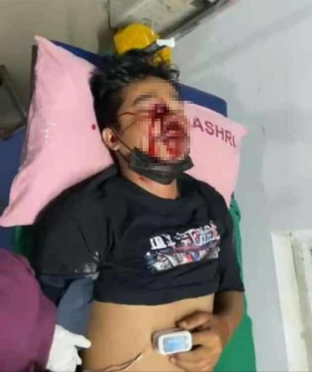 chingthou's tweet photo. Shooting pellets with a shotgun at close range can cause severe and potentially life-threatening injuries, which include Severe Tissue & Organ Damage, Risk of Fatal Injuries, Facial & Eye Injuries, debilitating disabilities & psychological trauma
#ManipurCrisis #SecurityExcess https://t.co/OGgSGvncnu