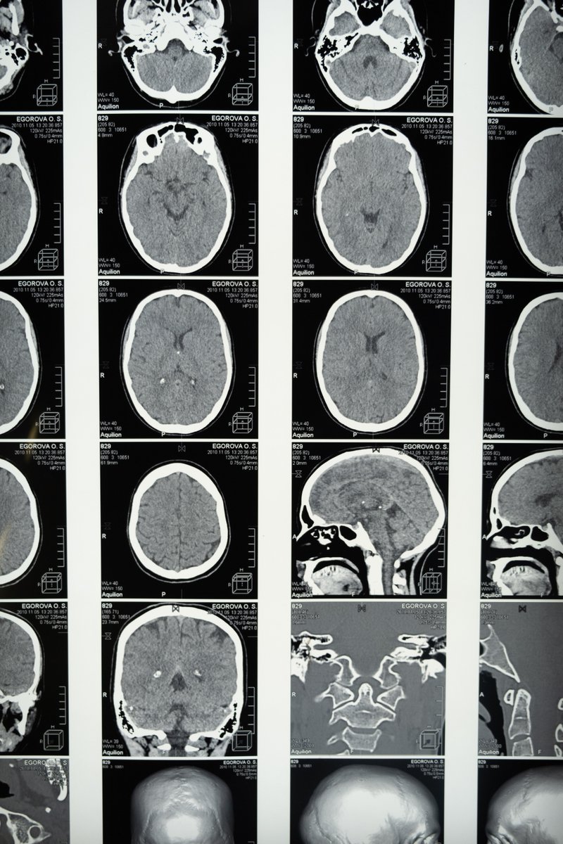 IOPPublishing's tweet photo. In our #BioPhysicsFeature this week, researchers are using AI to turn brain waves into audible speech - with up to 100% accuracy! Learn more about this incredible breakthrough here:
https://t.co/5XZfwXRT5o https://t.co/qkoBHAbIcL
