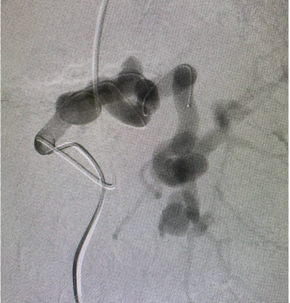 bsc_io_e's tweet photo. #EMBOLDcoils case out of @UNC_SOM by @NimaKokabiMD. A complex case treating 34yo PT w/ autoimmune hepatitis, pt was at high risk of bleeding from portal hypertension & splenic artery aneurysms. #Truselect and all 3 #EMBOLDcoils were used. https://t.co/ihdmVpjutg https://t.co/Bw2cKZaRZH