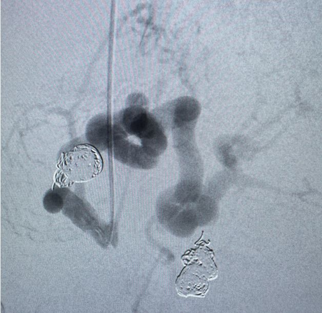 bsc_io_e's tweet photo. #EMBOLDcoils case out of @UNC_SOM by @NimaKokabiMD. A complex case treating 34yo PT w/ autoimmune hepatitis, pt was at high risk of bleeding from portal hypertension & splenic artery aneurysms. #Truselect and all 3 #EMBOLDcoils were used. https://t.co/ihdmVpjutg https://t.co/Bw2cKZaRZH