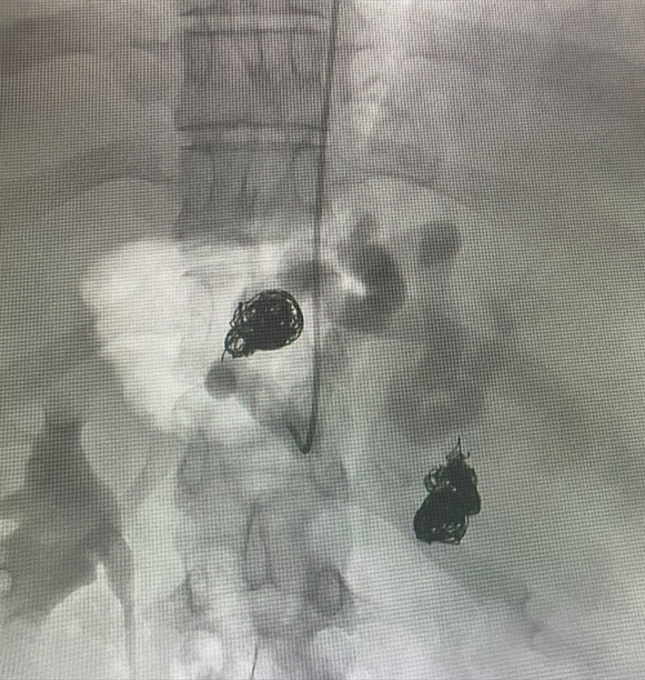 bsc_io_e's tweet photo. #EMBOLDcoils case out of @UNC_SOM by @NimaKokabiMD. A complex case treating 34yo PT w/ autoimmune hepatitis, pt was at high risk of bleeding from portal hypertension & splenic artery aneurysms. #Truselect and all 3 #EMBOLDcoils were used. https://t.co/ihdmVpjutg https://t.co/Bw2cKZaRZH