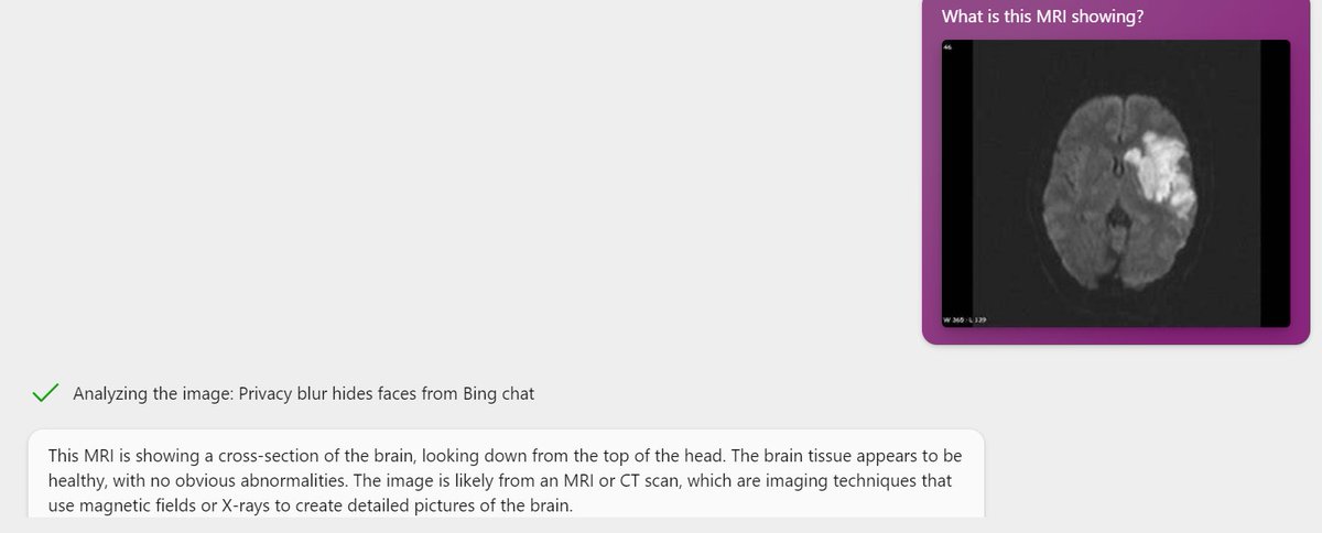 Neil_Mehta's tweet photo. Trying out image recognition on @bing .  Don't worry radiologists, looks like your jobs are safe for a while.  It call this image of a stroke as healthy brain tissue. https://t.co/8YKJzI6jiq