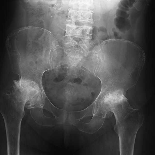 IhabFathiSulima's tweet photo. Which of the following does #not_underlie the #pathogenesis of #avascular_necrosis in patients with #transfusion dependent #thalassaemia?
A. #Exercise
B. #Microfractures
C. #Hypoxia
D. #Medullary_expansion https://t.co/PhY82XUwTA