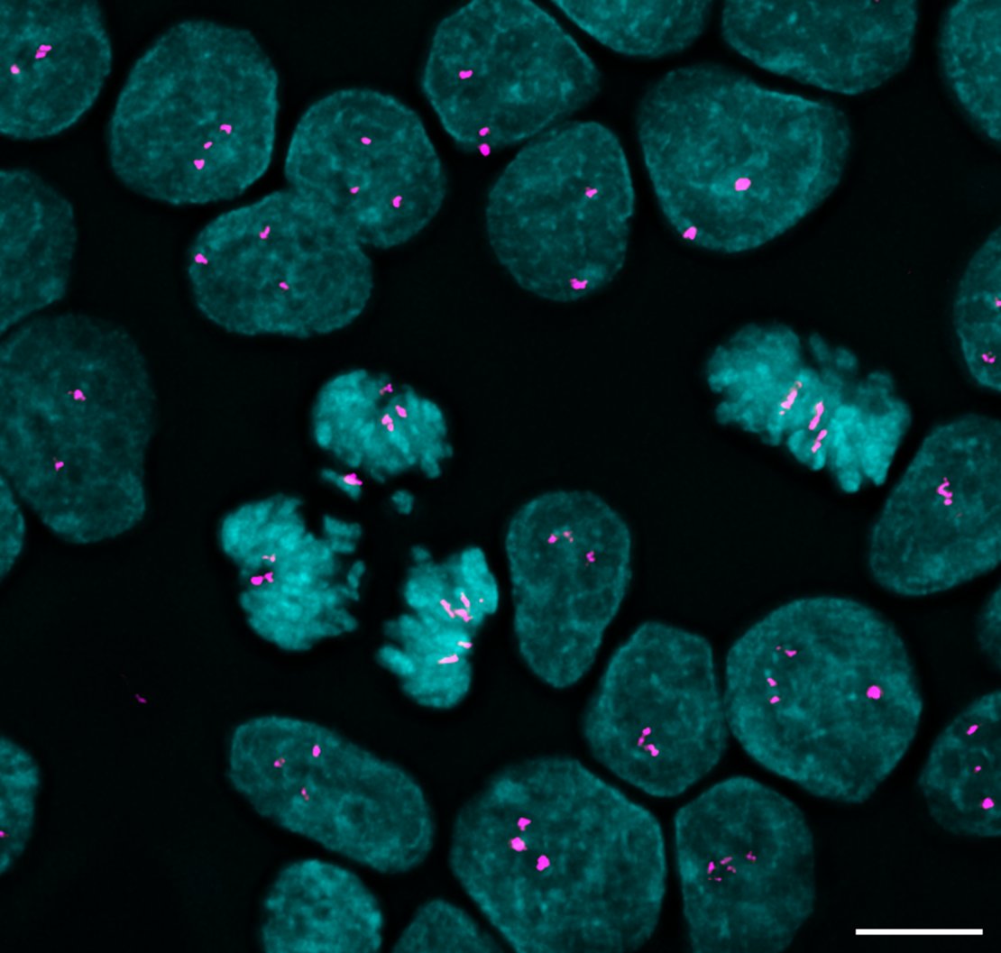 Sometimes, after scanning coverslips for hours in the dark, you find a weird little cell that reminds you of how cool your research is👩‍🔬 Pictured: a tripolar mitosis where we are able to identify which chromosome is lagging through the use of FISH🔬#aneuploidy #stemcells