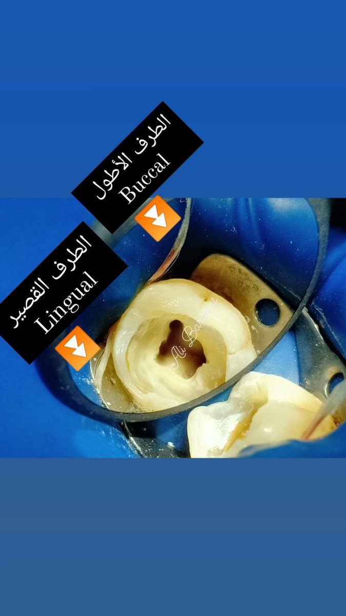 تريكايه اخترعتها كده بسيطه اوي 😂
اي حد بيشتغل اندو ف البدايه مش بيعرف يحدد من الميرور أنهي MB canal وأنهي ML
بالذات لما يكون الضرس عاوز بيلد اب والوول طايره كلها وبالذات برده مع اختلاف ال angulation أو بالذات لما يكون جوه الكانالز كلها فايلات ومش عارف تحدد مين داخل فين !