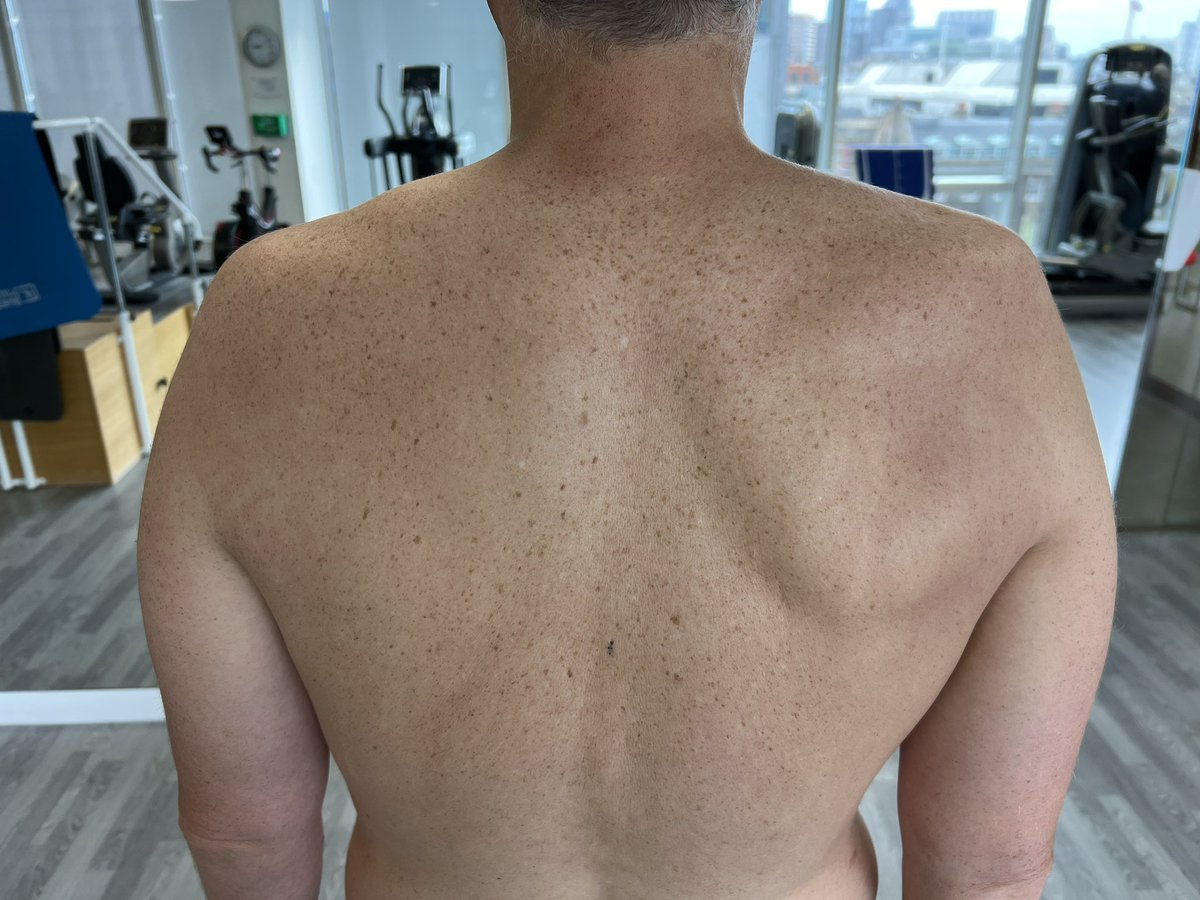 A case of Parson Turner syndrome after “aggressive” soft tissue treatment in the neck and shoulder area. Patient developed acute neuropathic pain post treatment and subsequent right upper girdle wasting.

A reminder not to go prodding too vigorously in the triangles of the neck?