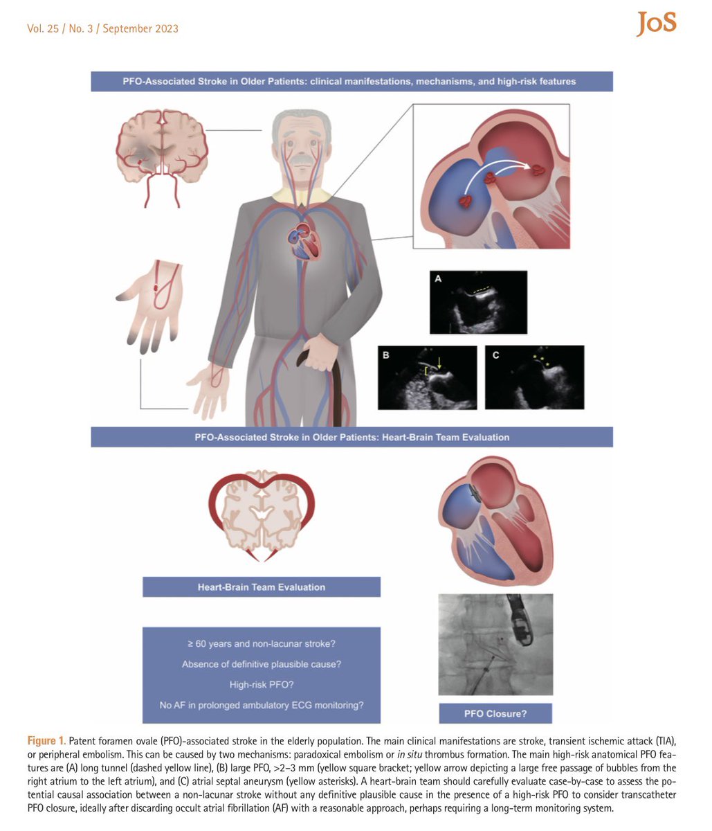 Julio_Farjat's tweet photo. #Cryptogenic #stroke in older patients (>60y) with patent foramen ovale: to close it or not? 

What you need to know around your clinical decision.

Just out: Journal of Stroke (IF: 8.2) #PFO #StructuralHeart #PhD @sidmengi_dr @IUCPQ #CardioTwitter

https://t.co/Y7wmZHujTd https://t.co/PkWM2D6fNv