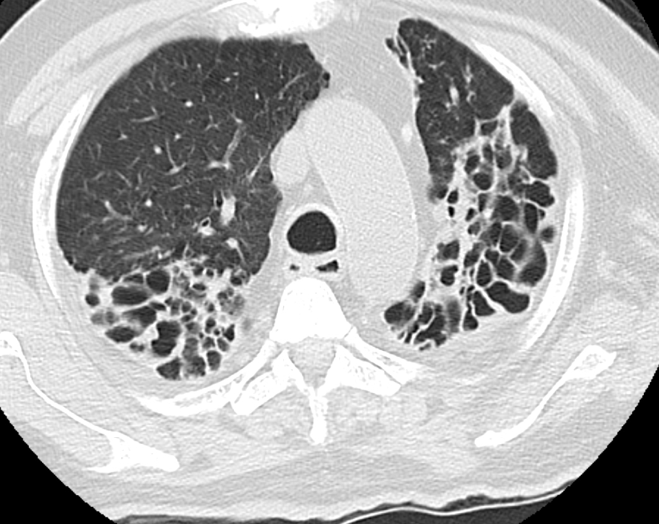 IhabFathiSulima's tweet photo. What is the #pulmonary disease ?
#medtwitter https://t.co/Ec6Z8cxzxg