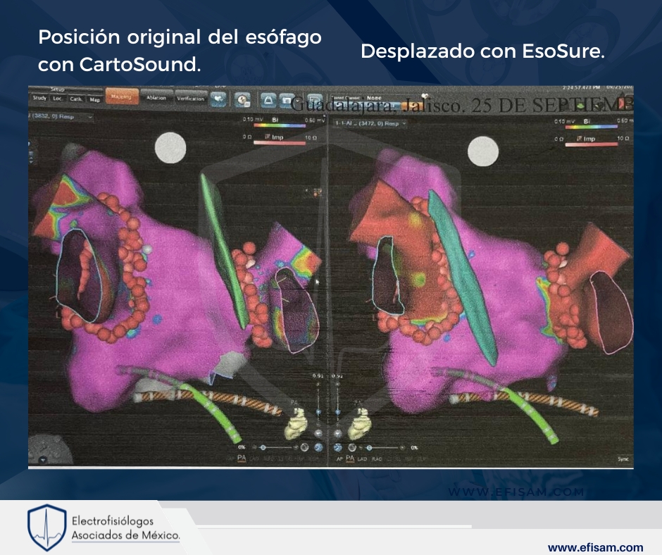 DrAlexCordero's tweet photo. Recientemente, hemos llevado a cabo con éxito una ablación que ha tenido un impacto positivo en la calidad de vida de nuestros pacientes. Utilizando la combinación de #EsoSure y #CartoSound 

#efisam #electrofisiologos #cardiologos #arritmiascardiacas  #dralejandrocordero https://t.co/IgbVpURC14