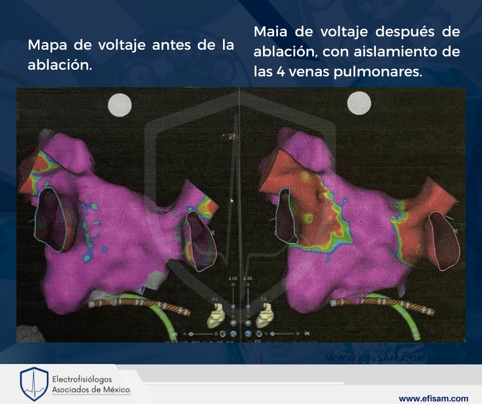 DrAlexCordero's tweet photo. Recientemente, hemos llevado a cabo con éxito una ablación que ha tenido un impacto positivo en la calidad de vida de nuestros pacientes. Utilizando la combinación de #EsoSure y #CartoSound 

#efisam #electrofisiologos #cardiologos #arritmiascardiacas  #dralejandrocordero https://t.co/IgbVpURC14