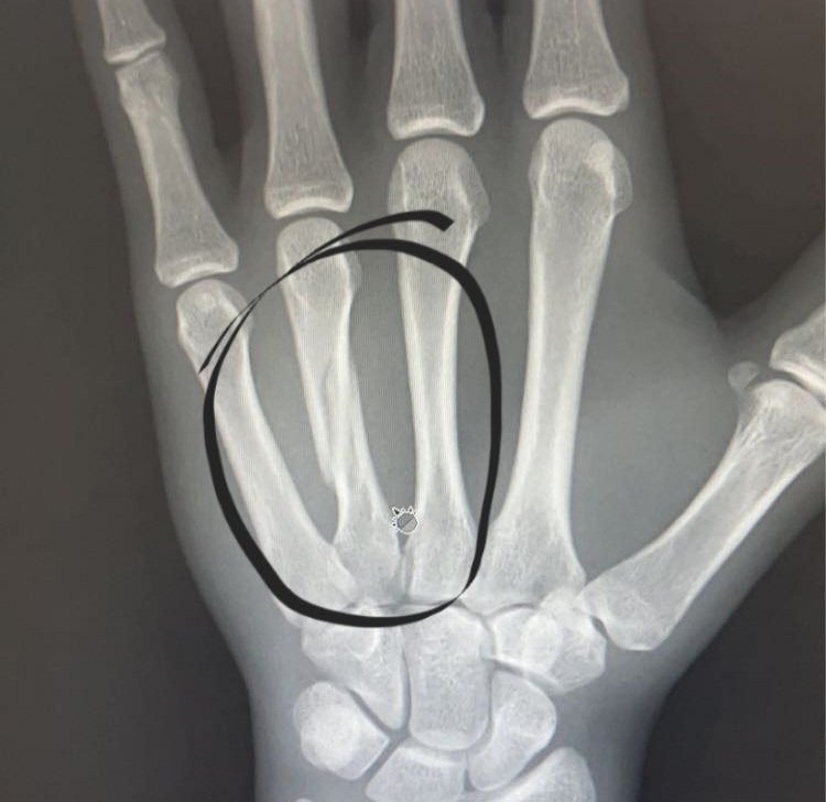 Georgiepiesix's tweet photo. Well devasting news for my Spider Monkey Broke his hand at a practice , so that's it for his senior football year π As of now no surgery neededπ In life obstacles come about , you just never want your children to be faced with them β€οΈβπ©Ή
#OnceABrave #9
@PrestonMay2024 https://t.co/BSnRJvvuJ9