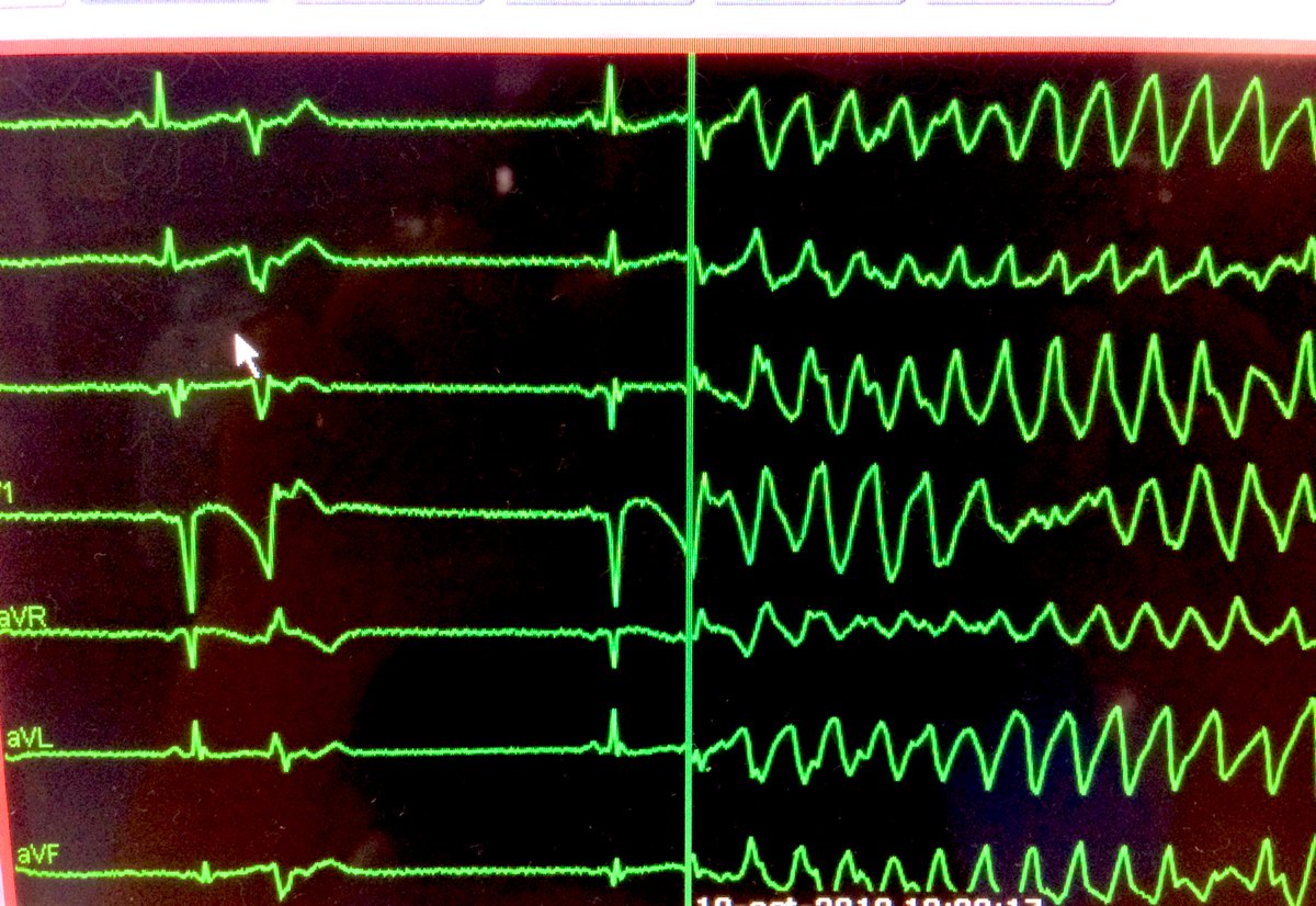 La ablación con catéter se debe considerar en pacientes con episodios recurrentes de TVP/FV desencadenados por EV similares, que no responden al tratamiento médico o a la revascularización coronaria #CardioTwitter #guiasAV22 @SeguraCardio @chuletadeosler @ACH_epteam @CopGAG