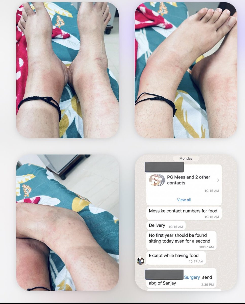 Indian__doctor's tweet photo. Brutal Torture with female Surgery Resident Doctor
at VMMC ,Safdarjung hospital by Seniors!

★No 1st yr should be found sitting today
★I was abused , made to work for 110 hours of continuous duty till cellulitis developed in my feet&amp; yet were not allowed to sleep⤵️ 
#medTwitter https://t.co/35Cdf8ytu1