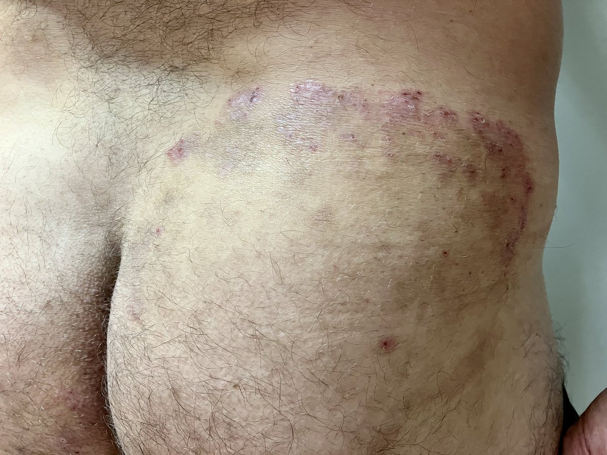 allobe86's tweet photo. Varón de 50 años con está lesión en la nalga.
¿Qué otra parte del cuerpo es necesario explorar para llegar al diagnóstico?
#dermatology #dermatología #2MIR24 #MIR24 #ENARM2023 #dermaquiz #dermachallenge https://t.co/6zqbFFBN9k