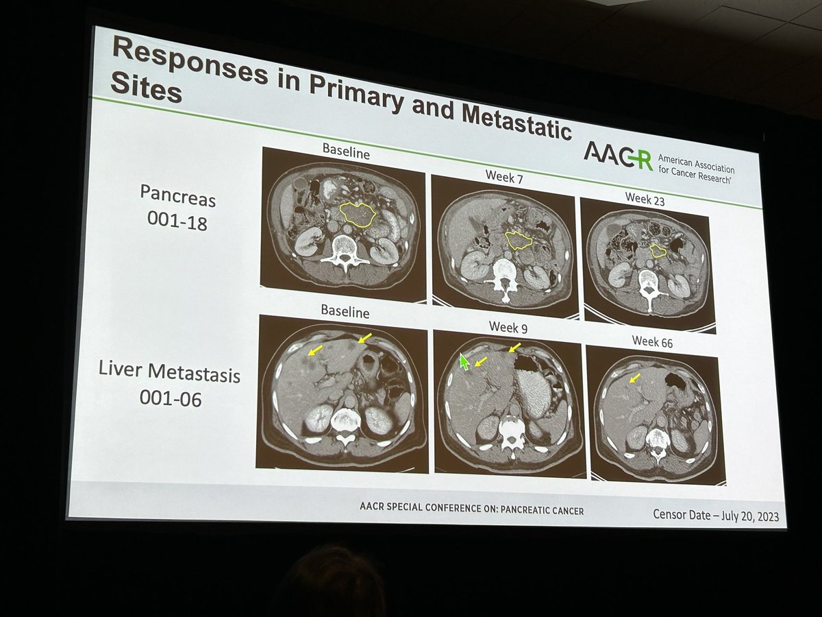 #AACRPan23 talk by Dr. Gulam Manji @columbiacancer on CheMoMETPANC 👉🏽 gemcitabine plus nab-paclitaxel + motixafortide (CXCR4 antagonist) + cemiplimib in advanced #PancreaticCancer. Responses observed in both primary & metastatic sites, with 64% partial responses & 27% stable