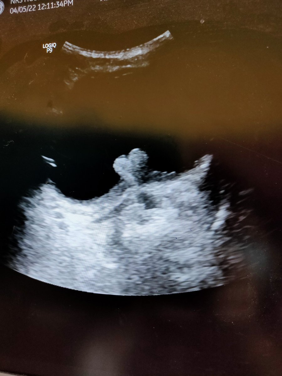 Is that a Heart in the bladder or an intravesicle prostatic projection ?
#FOAMed #FOAMrad #USRAD #radXX #ABDrad #RADRes #Radiology #Prostate #Sonography #USG #ultrasound