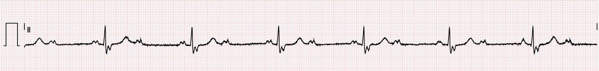 We aren't being replaced by robots quite yet 🤖🤖🤖

What do you see in this ECG tracing in a patient with TBI from syncope? 

The computer read it as 'sinus bradycardia'.  🫀

Neurointensivist 1, ECG machine 0 🥊🥊🥊

#medtwitter #meded #neurotwitter #stroke #neurologyrf