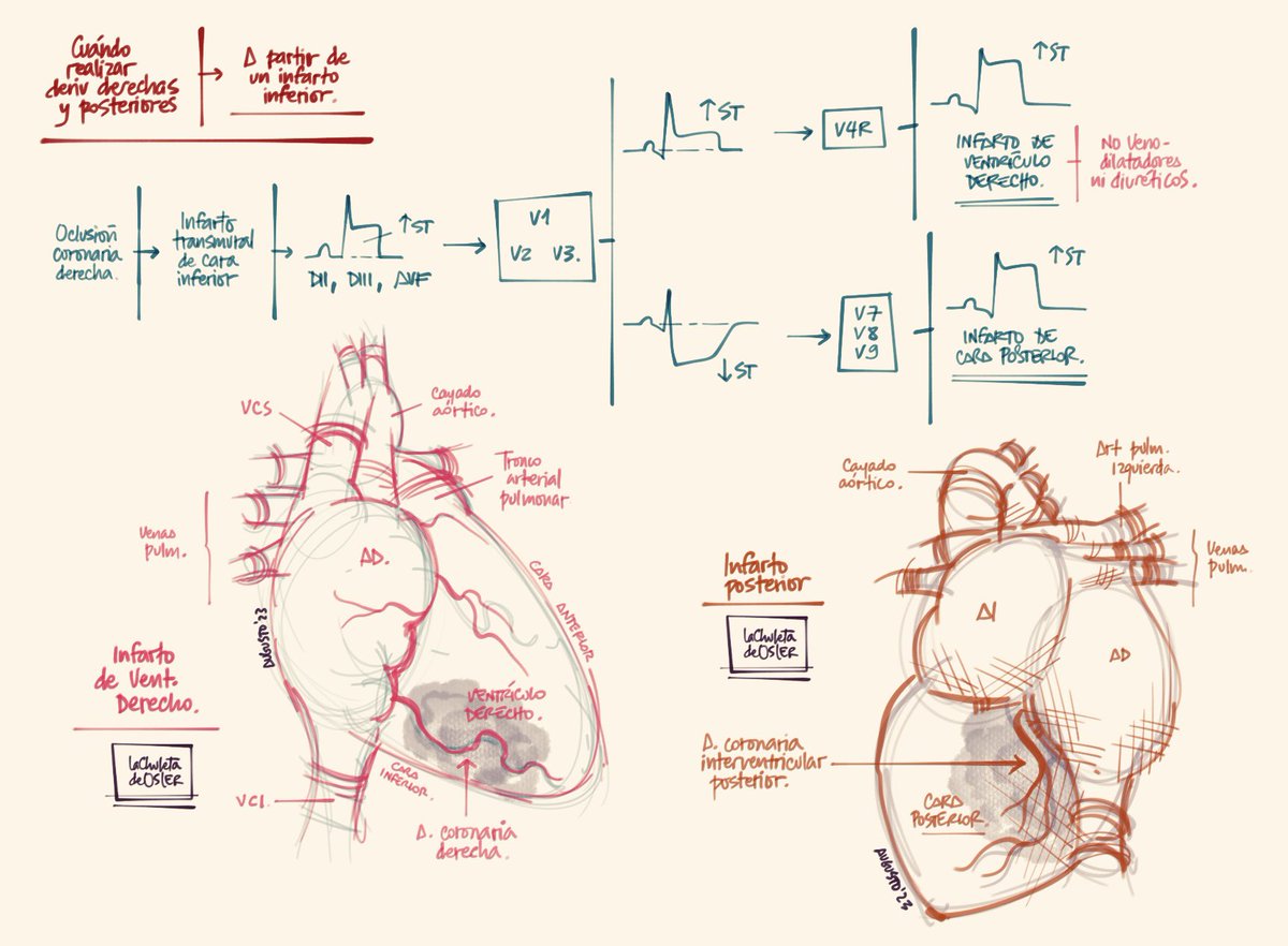 chuletadeosler's tweet photo. Infarto de ventriculo derecho e
infarto de cara posterior. https://t.co/5x1E23KfGW