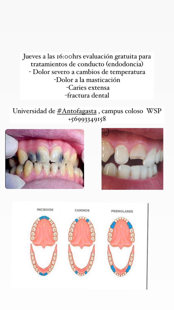 paz837's tweet photo. Hola!Soy estudiante de odontología y busco pacientes para tratamientos de conducto (endodoncia)Jueves a las 15:00hrs evaluación
(Solo los dientes de la imagen)

Dolor severo a cambios de temperatura
Dolor a la masticación
Caries extensa
fractura dental
 +56993349158 #Antofagasta https://t.co/l4BcplSlfZ