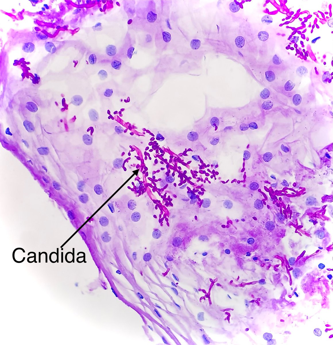 It’s Candida Friday Party Time 🥳 #PathTwitter #PathMatch2024 #Match2024 #Crittersontwitter #Pathbugs #pathology