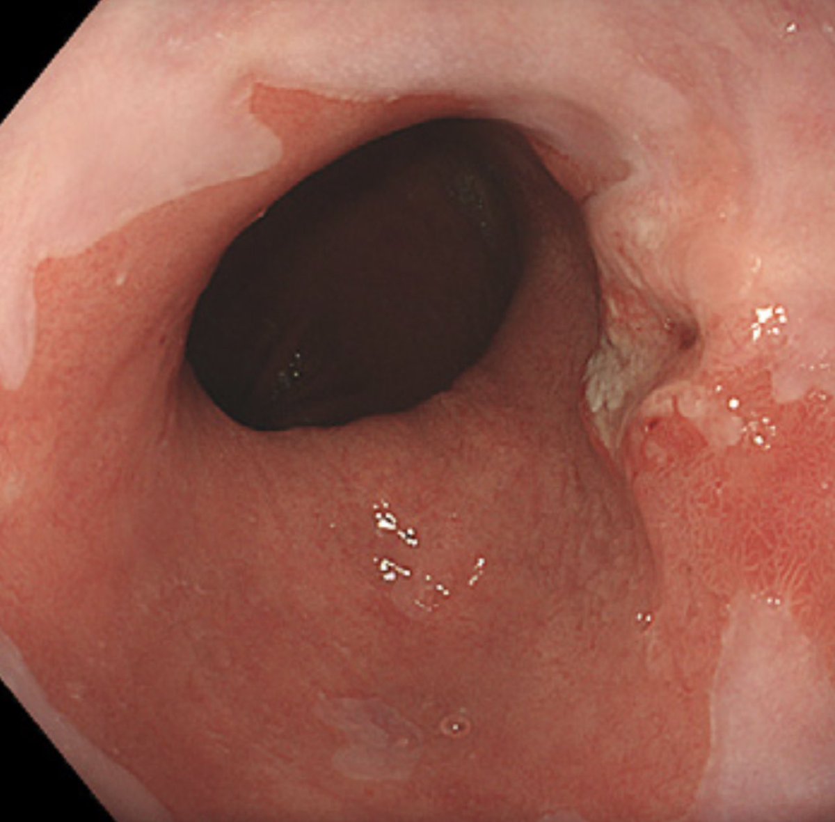 Patient with chronic reflux. What’s the diagnosis?