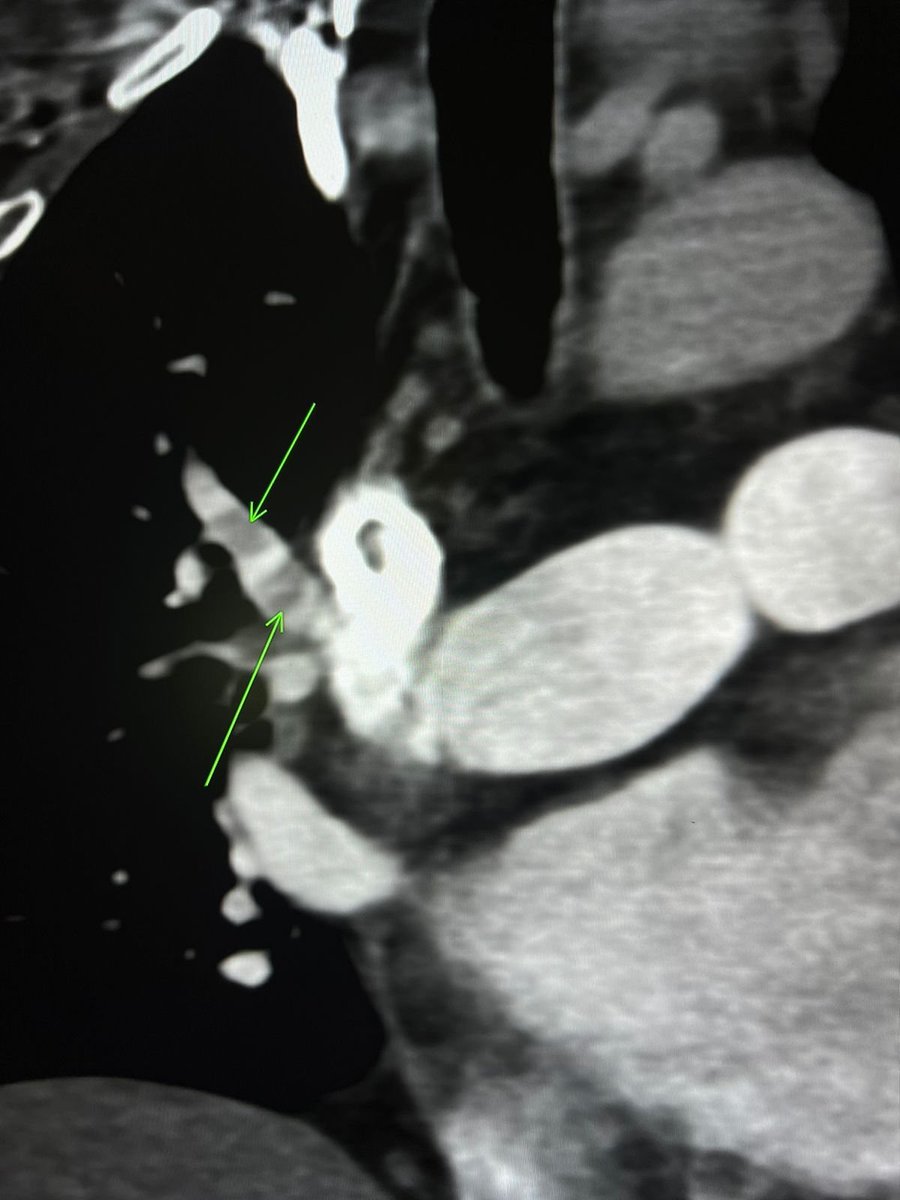samrad77's tweet photo. CTPA pitfall: A streak artifact from the contrast in the SVC (especially from the right-sided injection) can look like a filling defect in the right upper lobar pulmonary artery or the right main pulmonary artery. 

This is a common diagnostic pitfall. Be aware of this artifact and don't overall it pulmonary embolism.