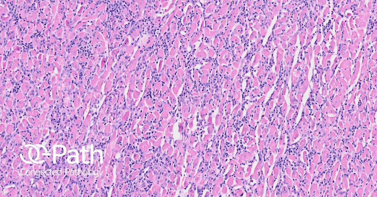 C_Pathology's tweet photo. #WORLDHEARTDAY 

🔬 The #WholeSlideImage below shows pathological signs of cardiomyopathy; infiltration of lymphoplasmacytic inflammatory cells, degeneration, and necrosis of cardiac myofibers. https://t.co/5x6sMmYBAg