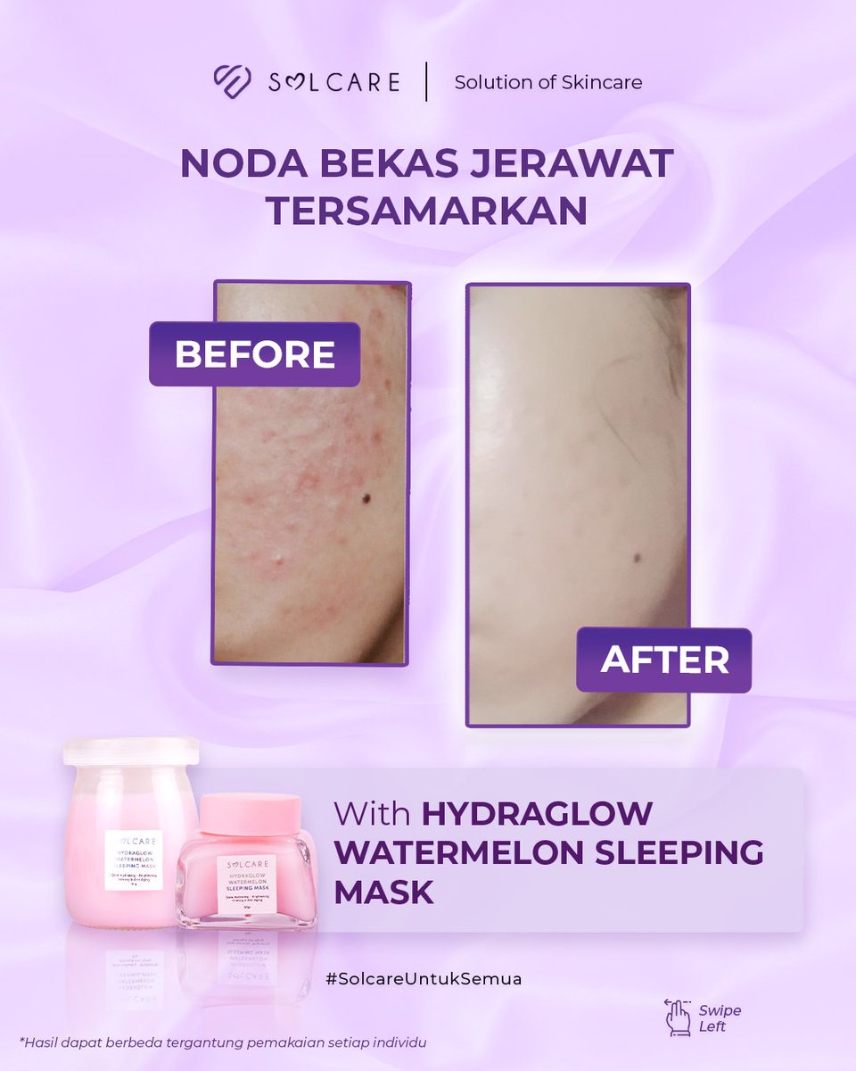 solcare_id's tweet photo. Keliatan banget kan hasilnya setelah pemakaian rutin dari Hydraglow Watermelon Sleeping Mask 🤩

Kemerahan mereda dan juga kulit jadi tampak lebih cerah! ✨

Siapa disini yang udah cobain juga hasil dari Hydraglow Watermelon Sleeping Mask? ☝🏻👀 https://t.co/KAuu2dT8n7