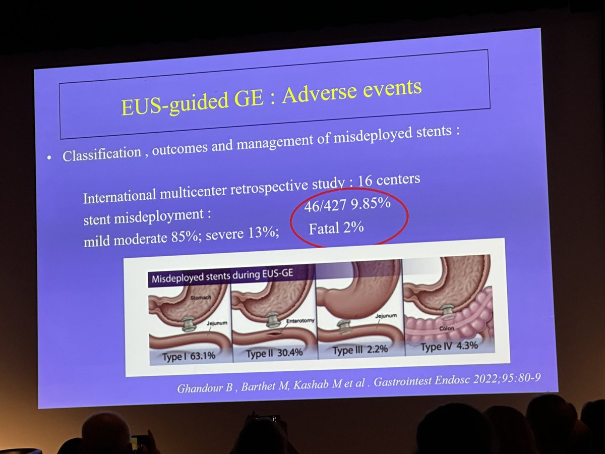 SyedGerdezi's tweet photo. Marc Barthet showing the endless possibilities of therapeutic #EUS and #LAMS Beyond the conventional #CDS #GE #EDGE #HGS
A great talk about
Gastro-Gastric #EUSGG
Jejuno-Jejunal #EUSJJ
Gastro-Colonic #EUSGC
Entero-Enteral-ERCP #EDEE
Anastomosis.
#EUSEndo2023 https://t.co/9lufcG10O9