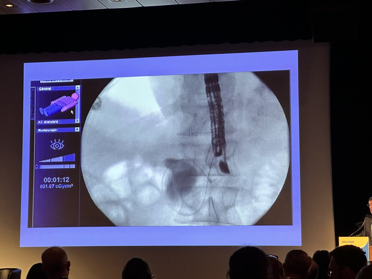 SyedGerdezi's tweet photo. Marc Barthet showing the endless possibilities of therapeutic #EUS and #LAMS Beyond the conventional #CDS #GE #EDGE #HGS
A great talk about
Gastro-Gastric #EUSGG
Jejuno-Jejunal #EUSJJ
Gastro-Colonic #EUSGC
Entero-Enteral-ERCP #EDEE
Anastomosis.
#EUSEndo2023 https://t.co/9lufcG10O9