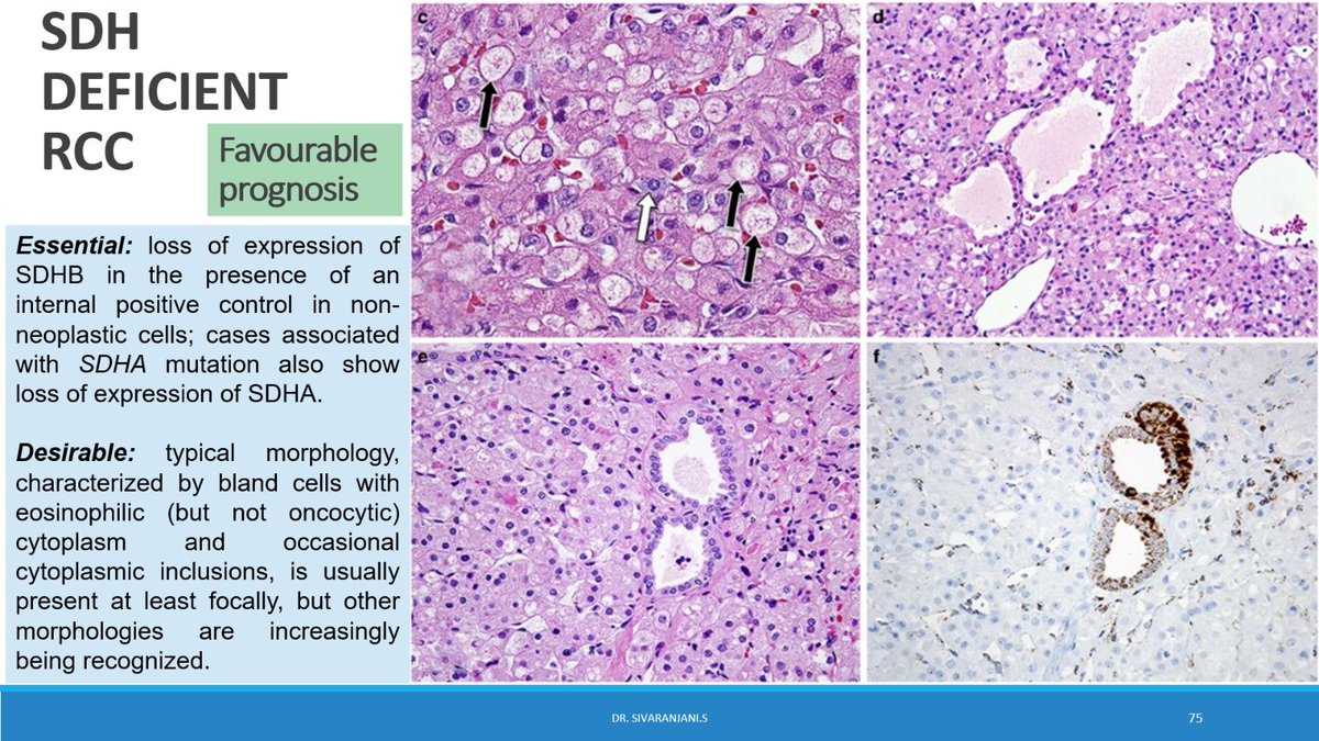 oncopath_siva's tweet photo. Molecularly defined RCC -WHO 2022 MGT and primary system
#gupath #KAPCONPathX2023 #KAPCON2023 https://t.co/0fU82kq5gu