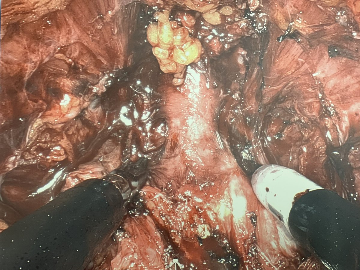 DrShakuriRad's tweet photo. I feel that with the SP system I am able to more consistently get long urethral length due to the angles of approach that the system provides. I donβt think I can go back to Xi anymore π€π§
#roboticsurgery @IntuitiveSurg #singleportrobotics https://t.co/tFcfr2cS0K