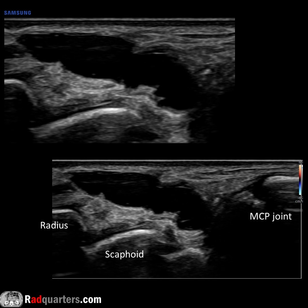 Dorsal wrist ganglion cyst. May see pedicle connecting to joint. Dorsal wrist most common location. Unlike joint recess fluid & bursal collections, will not collapse with compression. Watch📽️ to learn more: bit.ly/rq-ganglion @BostonImaging @SamsungHealth #FOAMrad