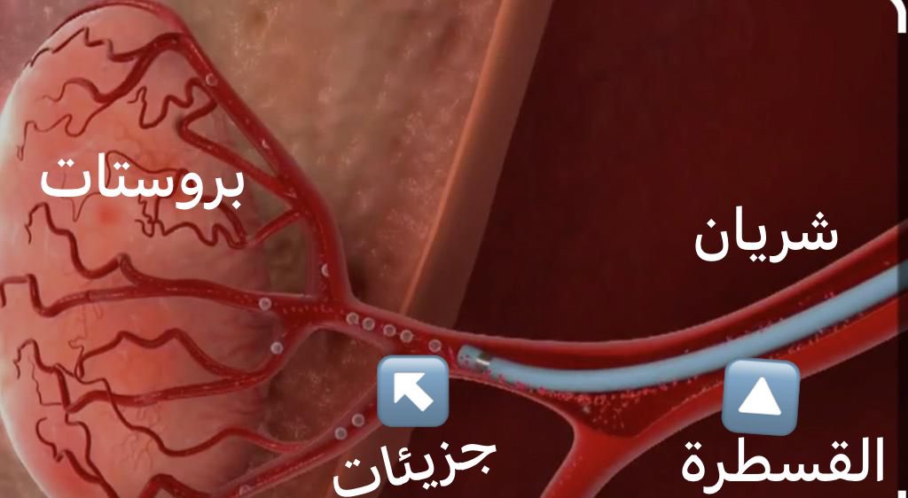#تضخم_البروستاتا الحميد. اعتمدت جمعية المسالك الامريكية القسطرة كخيار طبي في أحدث توصياتها 2023 AUA guidelines . بالقسطرة   يتم اقفال الدم بجزيئات صغيرة تعمل علي انقاص حجم البروستاتا بنجاح يصل الى ٩٠٪ #بدون_جراحة