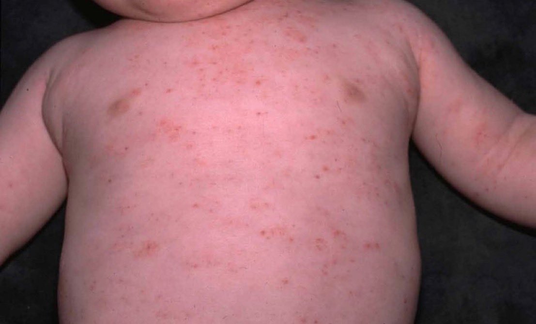 BrownJHM's tweet photo. An infant p/w easy bruising. Exam w/petechiae &amp; purpura in multiple areas over his body. Eczematous patches are also found on his flexural surfaces. Labs w/platelets 30,000/mm3. Hx of recurrent pneumonias &amp; epistaxis +. What is the likely diagnosis? #MedEd #pediatrics https://t.co/cMMclpnzjz