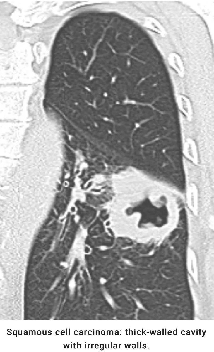 PulmCrit's tweet photo. fresh chapter: cavitary lung lesions!

🕳️ broad differential (the usual suspects: infection, malignancy, inflammatory)

🕳️ key clues include number, location, wall thickness, surrounding lesions

🕳️ air-crescent sign suggests aspergillus, but not always

https://t.co/K35NkMVHtQ https://t.co/yWV9sQXaTU