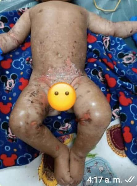 InforTvenezuela's tweet photo. Leudys de los Angeles de 24 años,fue detenida en Área de emergencia pediátrica del Hospital Dr. Manuel Nuñez Tovar por delitos en la LOPNNA en Maturín,edo Monagas.
Su hija de 10 meses presentaba desnutrición,severas quemaduras de segundo grado.
La infante murió tras larga agonía. https://t.co/josdJN9uCq