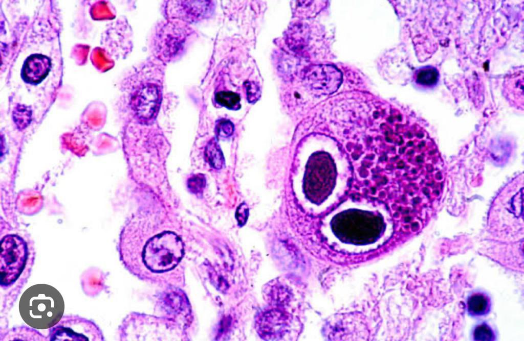 🦉🦉Owl’s appearance medicine 

1️⃣Owl eye inclusions-CMV infection

2️⃣Owl eye sign-Anterior spinal cord infarction on MRI

3️⃣Own eye-Reed sternberg cell in Hodgkin lymphoma

4️⃣Owl eye-lentiform nucleus of basal ganglia-cerebral hypoxia 

#MedX