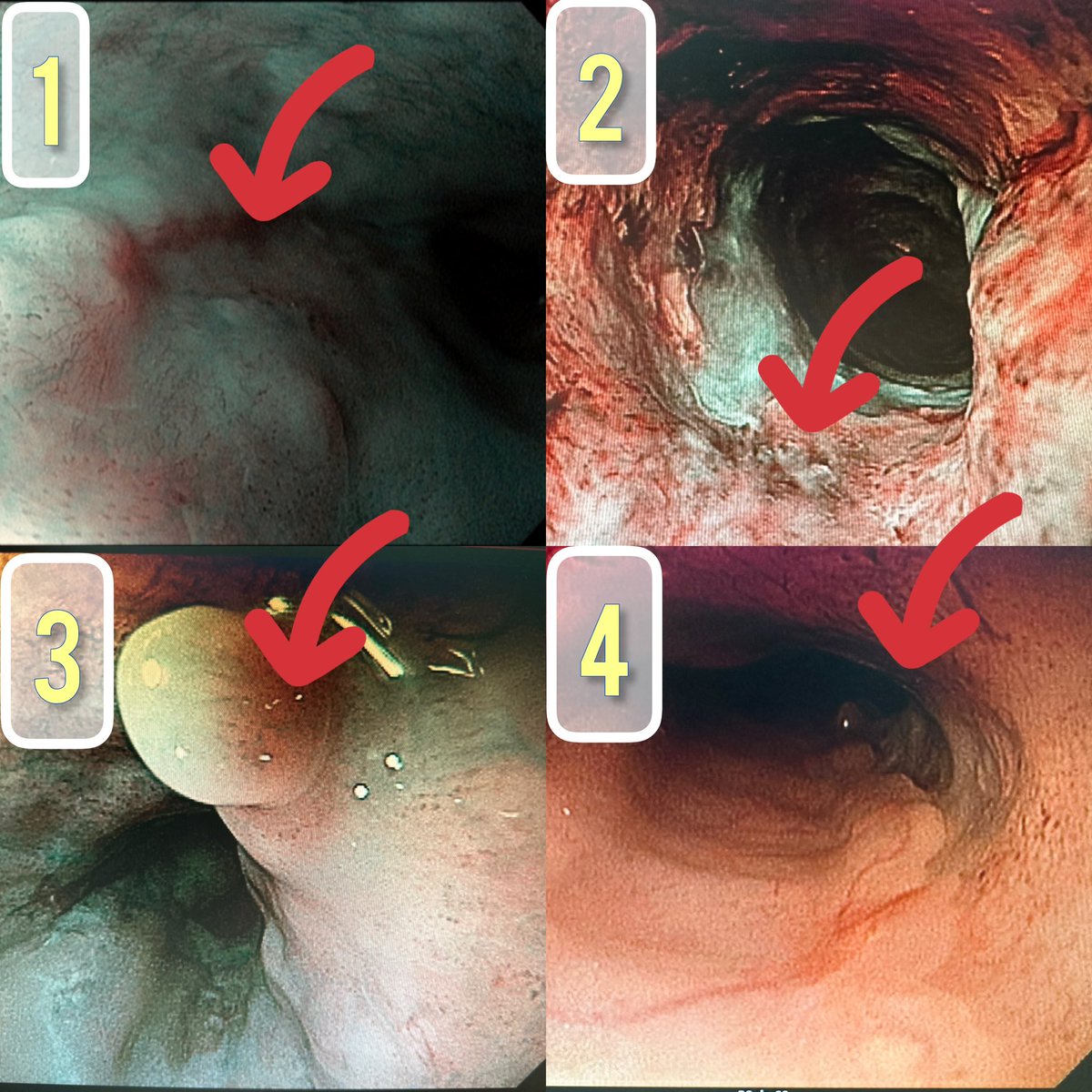 Flavio Roberto Takeda (@takedaflavio) on Twitter photo What number represents the total endoscopic clinical response after Chemo/Rdt at the AdenoEG junction?
<a href="/T4UGIS/">TUGSS</a> <a href="/ElliotServaisMD/">Elliot Servais, MD, FACS</a> <a href="/ISDE_net/">ISDE.net</a> <a href="/JessieAElliott/">Jessie Elliott</a> <a href="/JournalofGISurg/">JOGS</a> <a href="/MarkarSheraz/">Sheraz Markar</a> <a href="/LFerri123/">Lorenzo Ferri MD PhD</a> <a href="/cjvf06921572/">cjvf</a> <a href="/Maz_Surgery/">Maziar Navidi</a> <a href="/Vam_Jag/">Vam Jagadesham</a> <a href="/Chevallaym/">Mickael Chevallay</a> <a href="/AmCollSurgeons/">American College of Surgeons</a> <a href="/BrandaliseAndre/">André Brandalise</a> What number represents the total endoscopic clinical response after Chemo/Rdt at the AdenoEG junction?
<a href="/T4UGIS/">TUGSS</a> <a href="/ElliotServaisMD/">Elliot Servais, MD, FACS</a> <a href="/ISDE_net/">ISDE.net</a> <a href="/JessieAElliott/">Jessie Elliott</a> <a href="/JournalofGISurg/">JOGS</a> <a href="/MarkarSheraz/">Sheraz Markar</a> <a href="/LFerri123/">Lorenzo Ferri MD PhD</a> <a href="/cjvf06921572/">cjvf</a> <a href="/Maz_Surgery/">Maziar Navidi</a> <a href="/Vam_Jag/">Vam Jagadesham</a> <a href="/Chevallaym/">Mickael Chevallay</a> <a href="/AmCollSurgeons/">American College of Surgeons</a> <a href="/BrandaliseAndre/">André Brandalise</a>
