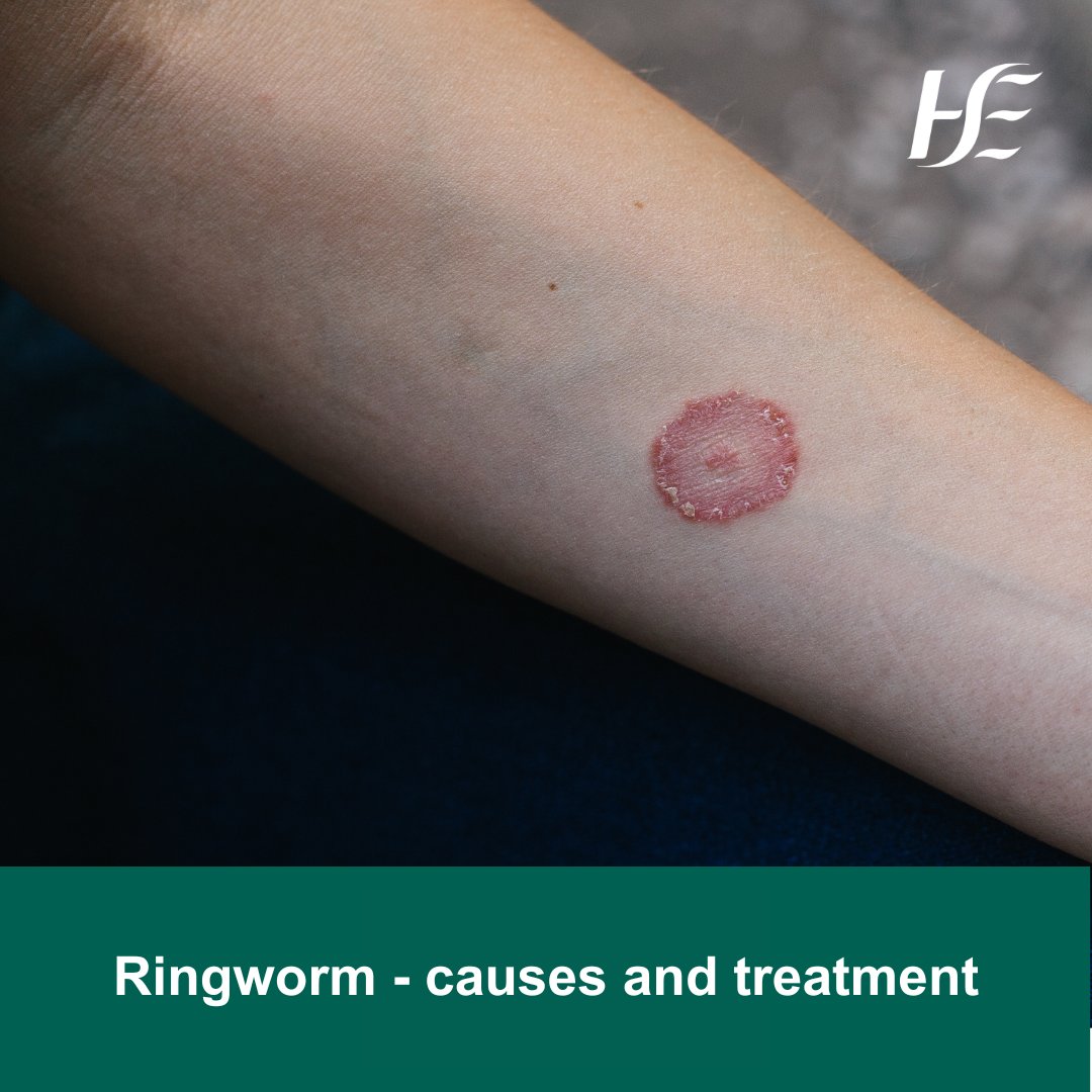 1,550 Ringworm Stock Photos - Free & Royalty-Free Stock Photos from  Dreamstime