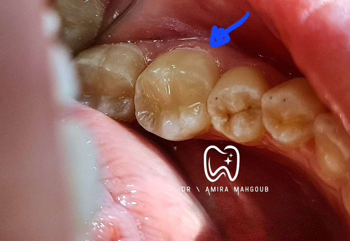 meerrryyyyy's tweet photo. Free hand composite restoration 🩷
لو الواحد معاه عدسه مايكرو وكاميرا كان ال secondary grooves بانت اكتر
بس يلا مش مهم بقي😂 https://t.co/59l5zFyx2X