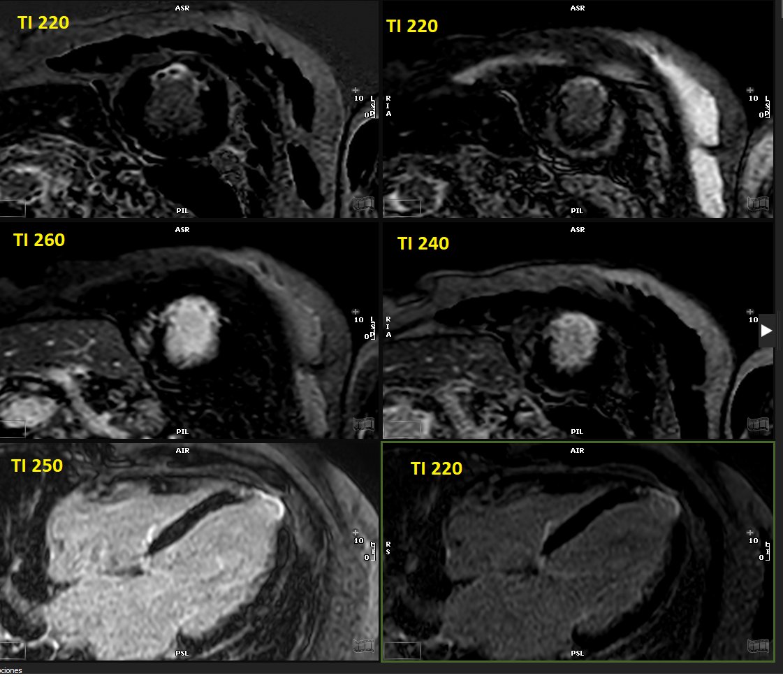 #WhyCMR LGE 'Grey Blood' ➡️Paramount for subendocardial AMI ➡️ Other uses: thin walls like apex, depict thrombus, AMI of PAP muscles! ➡️Select TI that turns blood grey (shorter than myocardial nulling time. ➡️This case TI 220 ms lowers blood pool signal! ⚖️Compare 260 vs. 220…