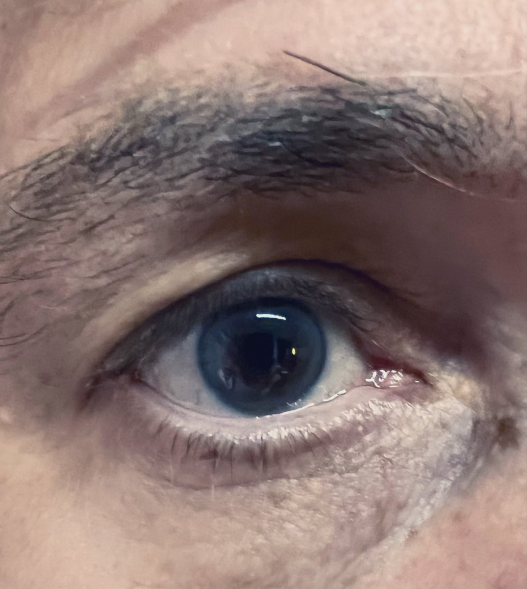drpablocorral's tweet photo. 45 y/o, Family Hx CAD 

LDLc 167 mg/dL
Lp(a) 198 nmol/L
ApoB 123 mg/dL

Corneal Arcus 
https://t.co/wNY7uqCTty

Frank’s sign
https://t.co/Z1lRLIXfGq https://t.co/DJoF0Atpyk