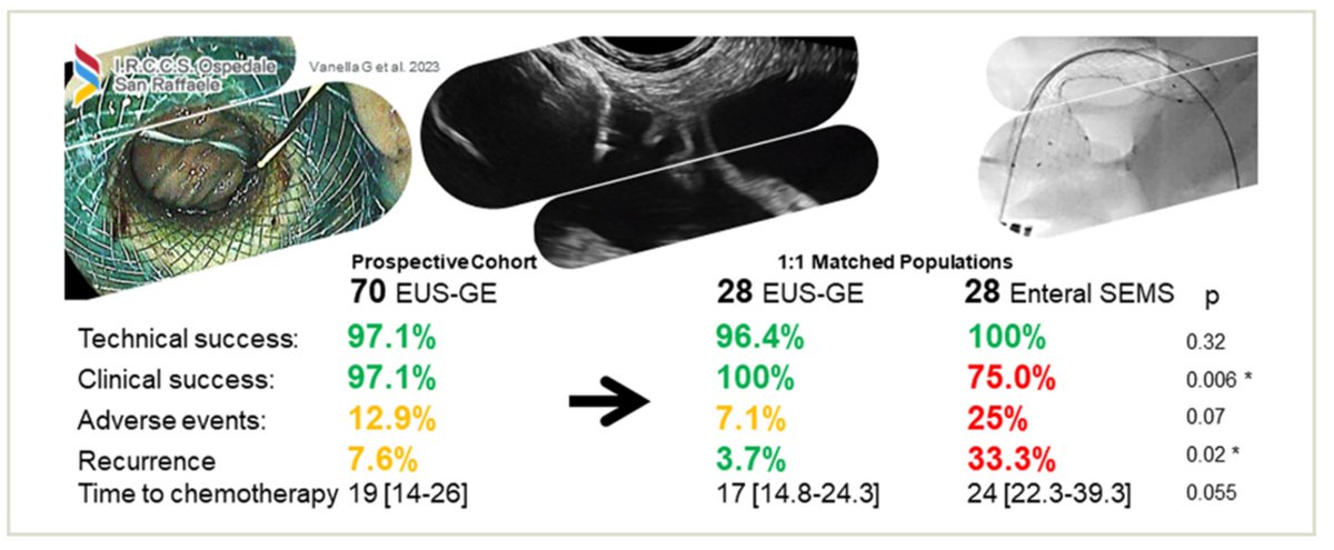 First prospective study comparing EUS-GJ and endoluminal stenting for GOO:

Following propensity score matching, EUS-GJ had better clinical success, and less adverse events / recurrence.

Implication for better QALY. What's your practice? 

giejournal.org/article/S0016-…