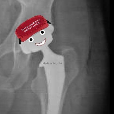 #MAGA #Trump2024 #NewHip #Hector
Me, hip replacement at 53. It's not the years. It's the miles.
#hipreplacement