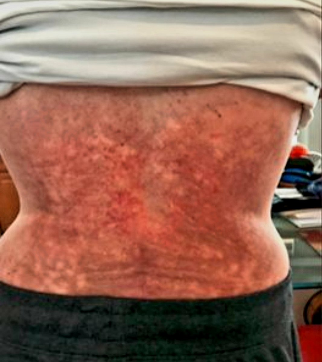 22 surgeries-my 23rd is scheduled in late November.

RA has wreaked havoc on my body where it hurts to simply type this tweet.

Burned &amp; scarred back due to the overuse of heating pads.

Chronic pain is debilitating-not treating w/meds &amp; other tools is criminal. 

#ChronicPain