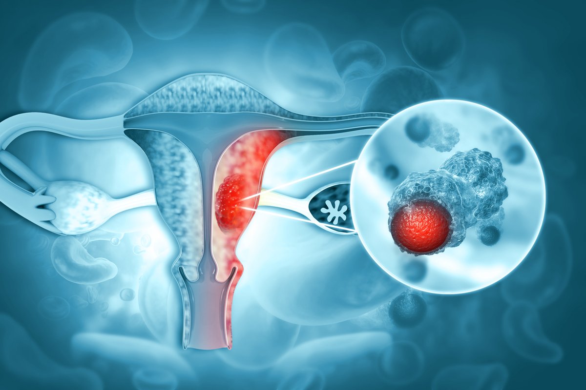 Rutgers Cancer Institute (@rutgerscancer) on Twitter photo <a href="/RutgersCancer/">Rutgers Cancer Institute</a>’s Dr. Lara Hathout <a href="/larahathout/">Lara Hathout</a> & colleagues present “Prognostic Impact of Mismatch Repair Deficiency on Stage I-II Endometrioid Endometrial Cancer Treated With Adjuvant Radiation Therapy: A Multi-Institutional Analysis” at #ASTRO23 astro2023.eventscribe.net/index.asp?sess… <a href="/RutgersCancer/">Rutgers Cancer Institute</a>’s Dr. Lara Hathout <a href="/larahathout/">Lara Hathout</a> & colleagues present “Prognostic Impact of Mismatch Repair Deficiency on Stage I-II Endometrioid Endometrial Cancer Treated With Adjuvant Radiation Therapy: A Multi-Institutional Analysis” at #ASTRO23 astro2023.eventscribe.net/index.asp?sess…