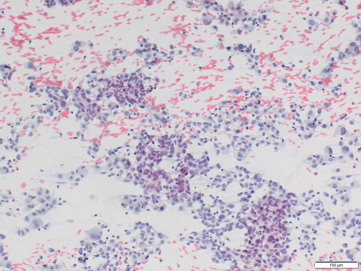 Cervical lymph node for this #FNAFriday: