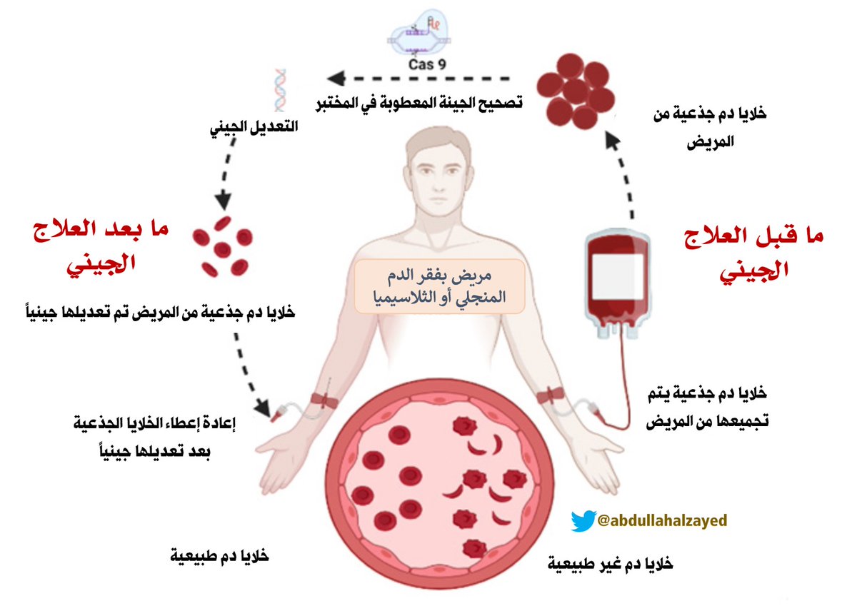 abdullahalzayed's tweet photo. #معلومة_اليوم 29

لقد وعدتكم قبل شهر بأني سأتحدث عن العلاج الجيني.. وحان أن أفي بوعدي 😃😉..

في الحقيقة هناك عدة أسئلة حول #العلاج_الجيني، ولكن السؤال المهم هو: هل وصلنا؟.. والإجابة: حسنًا.. نحن على وشك الوصول! فبالتأكيد نحن أقرب إليه بكثير مما كنا عليه في أي وقت مضى، حيث كنا كأطباء نسمع عن هذا العلاج لأكثر من عقدين من السنوات، ولم نصبح أقرب إليه مثل الآن، فهناك أمل كبير في أن نتمكن من تقديم علاج شافٍ لـمرضى #فقر_الدم_المنجلي قريباً، وربما في غضون أقل من ثلاثة أشهر إن شاء الله تعالى، طبعاً إذا صدق حدسي!

أما السؤال التالي فهو عن العلاج نفسه! فعندما نتكلم عن العلاج الجيني يجب أن نقول بأنه ليس نوعاً واحداً وهذا يجعل الحديث متشعباً، فهناك طرق مختلفة لتعديل أو تغيير الجينات، إما بإصلاح الطفرة وتصحيحها كما نصحح كلمة "بصل" إلى كلمة "بطل"، حيث تؤخذ الخلايا من المريض ويتم تعديل الكروموسات المريضة في مختبر خاص، أو قد يكون معالجة المرض عبر إحداث تغييرات جينية مفيدة أخرى لعلاج #الأنيميا_المنجلية وذلك مثل تنشيط بروتين مسؤول عن تفعيل إنتاج #الهيموجلوبين_الجنيني HbF ويسمى BCL11، حيث أنه من المعروف بأن زيادة هذا الهيموجلوبين يؤدي إلى اختفاء أعراض المرض، والشعور برجوع الصحة للمستوى الطبيعي،  وللمعلومية فإن هذا الهيموجلوبين هو نفسه الهيموجلوبين الذي يرفعه علاج #الهيدروكسي_يوريا.

وقد تحدثت بالأمس عن #زراعة_النخاع لعلاج فقر الدم المنجلي، وقلت بأننا نحتاج إلى متبرع حتى نأخذ منه #الخلايا_الجذعية، ولكن مع الأسف أقل من 20٪ من محاربي المنجلي لديهم متبرعون، أما بالنسبة إلى #العلاج_الجيني فالمتبرع هو أنت نفسك، أي تتبرع لنفسك بنفسك، وكما يقول المثل الشعبي:"حلاة الثوب رقعته منه وفيه". ولكن قبل إعطاء الخلايا المعدلة جينياً للمريض، يلزم أن يتم تحضير المريض باستخدام أدوية كيمياوية (عادةً يعطى علاج اسمه "بوسلفان")، وذلك بهدف إزالة وقتل نخاع العظم الحالي وخلايا الدم كلها. وهذا العلاج التحضيري هو ما يرفع من مخاطر العلاج الجيني، وعليه يجب دائماً موازنة المخاطر مقابل الفائدة المحتملة. 

وللعلم فإن هناك عدة شركات مهتمة بهذا العلاج، منها شركة بلوبيرد بيو وهي نفس الشركة التي طورت منتج تمت الموافقة عليه بالفعل من أجل علاج #الثلاسيميا_الكبرى باستخدام فيروس ناقل، وهي تقنية تهدف إلى إيصال الجين الصحيح إلى خلايا الجسم عبر الفيروس نفسه وكأنه مظروف يحمل رسالة إلى نواة الخلية (انظر الصورة). كما أن هناك شركة فيرتكس وكرسبر حيث تم ابتكار علاج جيني آخر يستخدم تقنية #CRISPR لتحرير الجينات، وقادر على رفع مستوى الهيموجلوبين الجنيني️ HbF. 

وللمعلومية فإن هذه الوسائل العلاجية باهظة الثمن ومعقدة، ولن تكون متاحة بسرعة، أي أننا سنحتاج لعدة سنوات حتى يكون متاحاً لمرضانا،  بل  في الواقع حتى في الولايات المتحدة؛ لازال هناك حاجة إلى ضمان إمكانية حصول المرضى على هذه العلاجات عند الموافقة عليها واعتمادها. وعلى الرغم ذلك.. فهذه دعوة لي ولكم كي نبقى متفائلين، وليملأنا الرجاء والأمل!

دمتم بحفظ الله ورعايته🤲💐 

#SCD
#شهر_التوعية_بفقر_الدم_المنجلي
#SickleCellAwarenessMonth