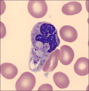 Patient with false thrombocytopenia. 

Etiology?. 🔬🤔
#hematology #citologia #MedTwitter #hemepath #fridaynight  #cito